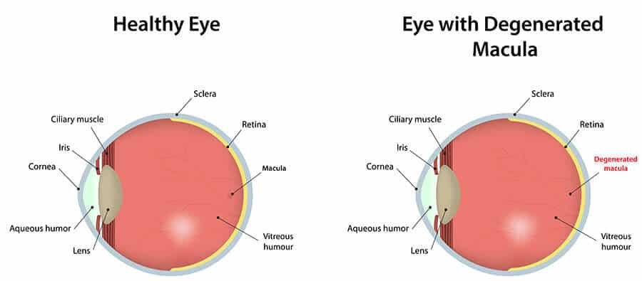 Understanding Macular Degeneration