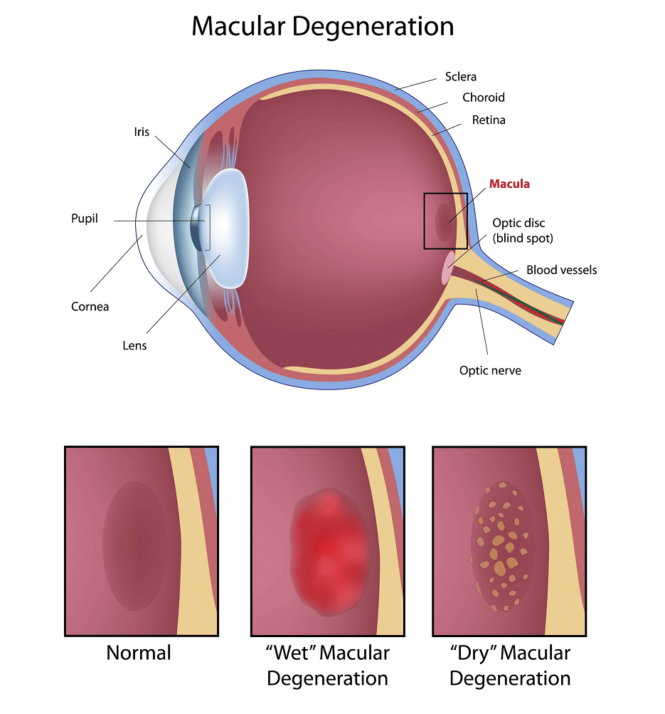 Understanding Macular Degeneration
