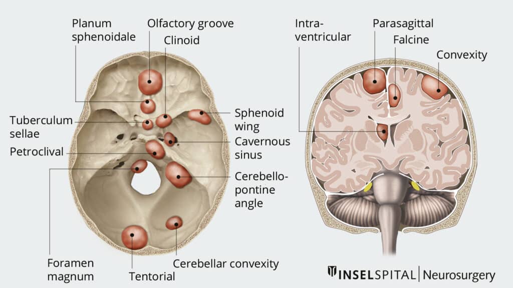Understanding Meningioma Tumors
