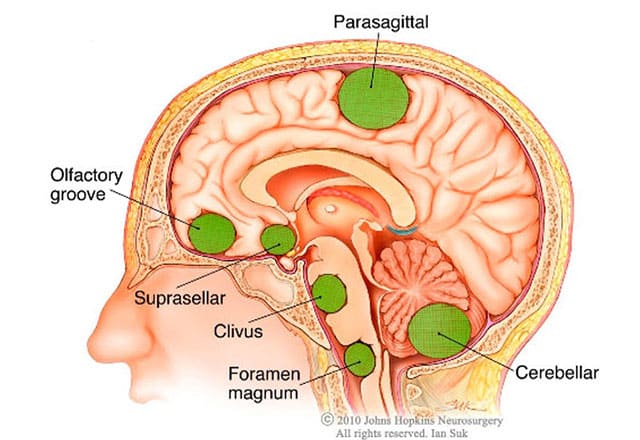 Understanding Meningioma Tumors
