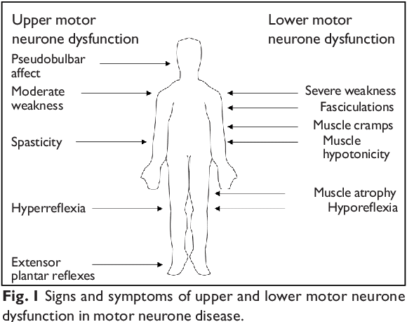 Understanding Motor Neurone Disease: Causes, Symptoms, and Treatment Options