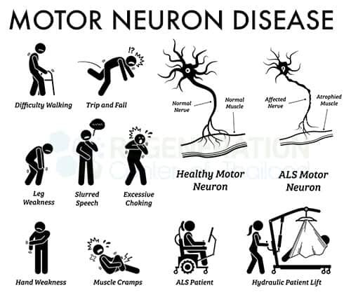 Understanding Motor Neurone Disease: Causes, Symptoms, and Treatment Options