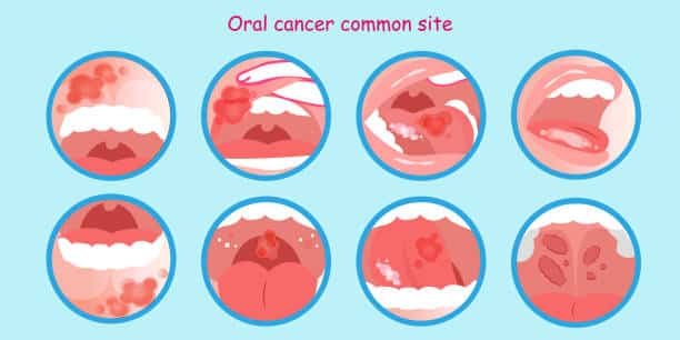 Understanding Mouth Cancer