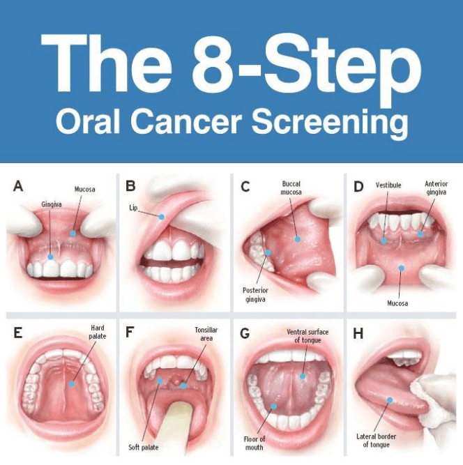 Understanding Mouth Cancer