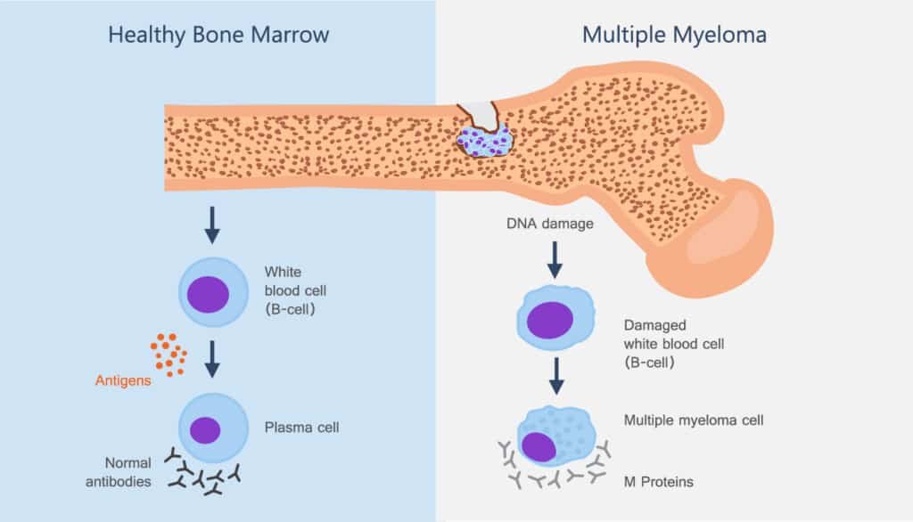 Understanding Multiple Myeloma