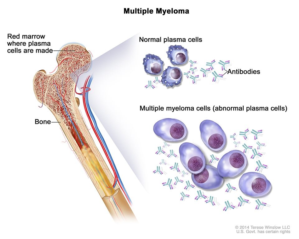 Understanding Multiple Myeloma