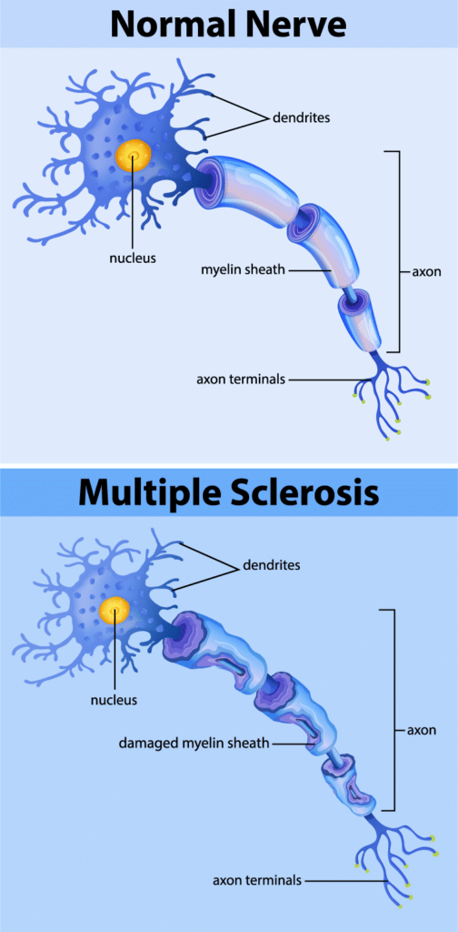 Understanding Multiple Sclerosis: A Comprehensive Guide