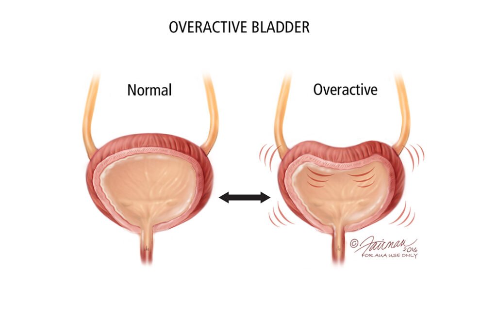 Understanding Overactive Bladder: Causes and Treatment