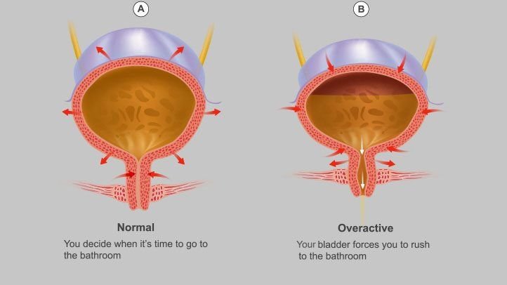 Understanding Overactive Bladder: Causes and Treatment