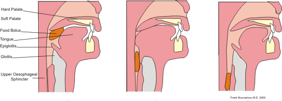 Understanding Swallowing Disorders