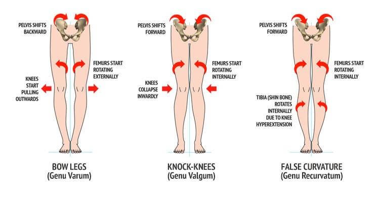 Understanding the Causes and Symptoms of Bow Legs