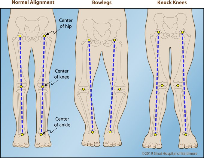 Understanding the Causes and Symptoms of Bow Legs