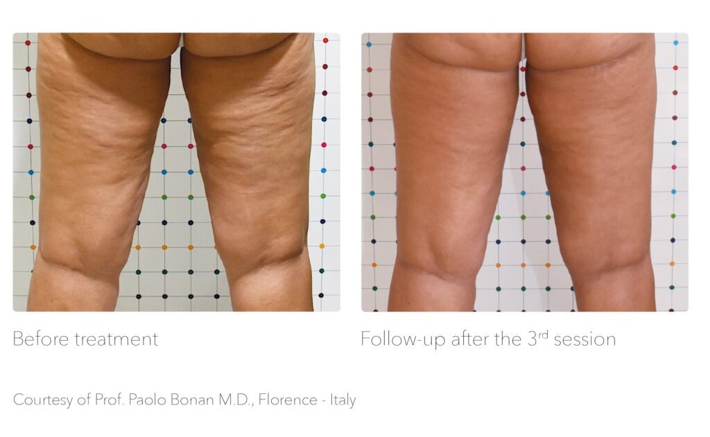 Understanding the Causes and Treatment of Cellulite
