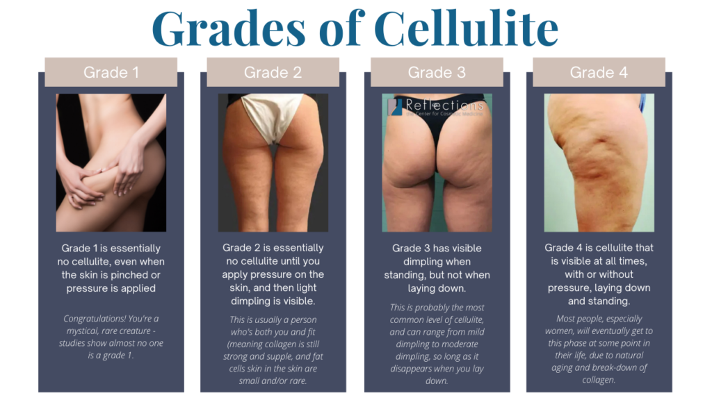 Understanding the Causes and Treatment of Cellulite