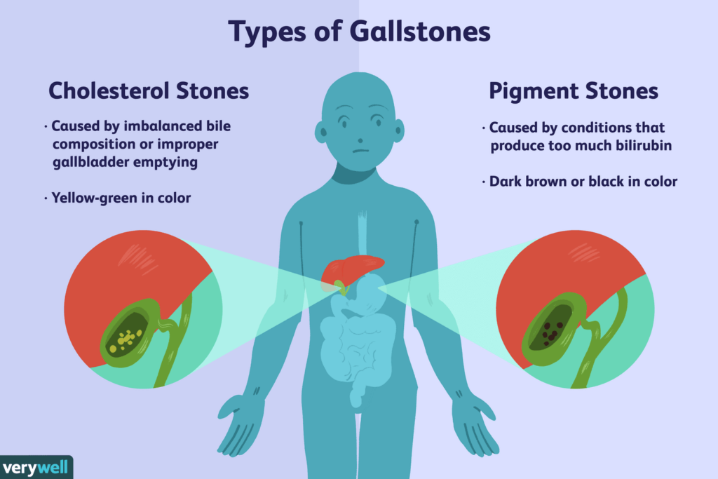 Understanding the Causes of Gallstones
