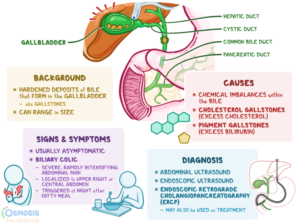 Understanding the Causes of Gallstones