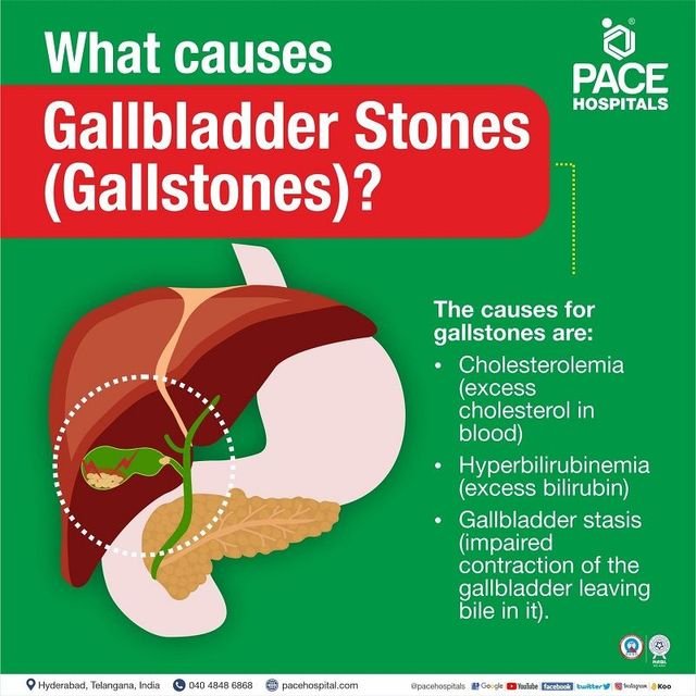 Understanding the Causes of Gallstones