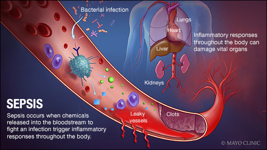 Understanding the Dangers of Blood Poisoning