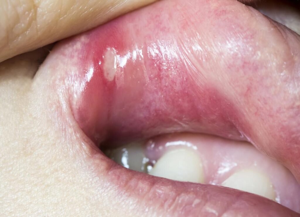 Understanding the Different Types of Mouth Ulcers