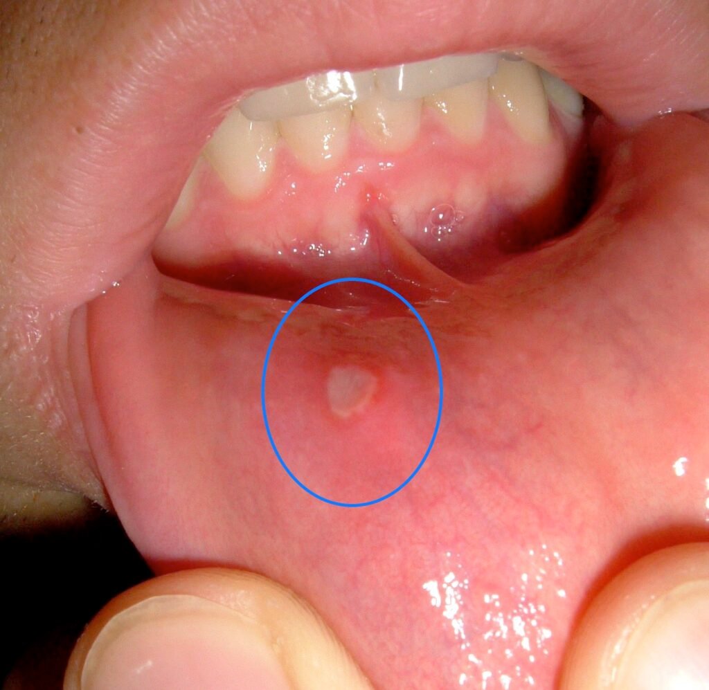 Understanding the Different Types of Mouth Ulcers