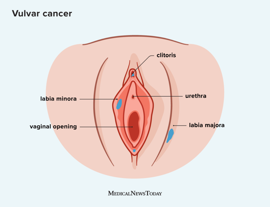 Understanding Vulval Cancer