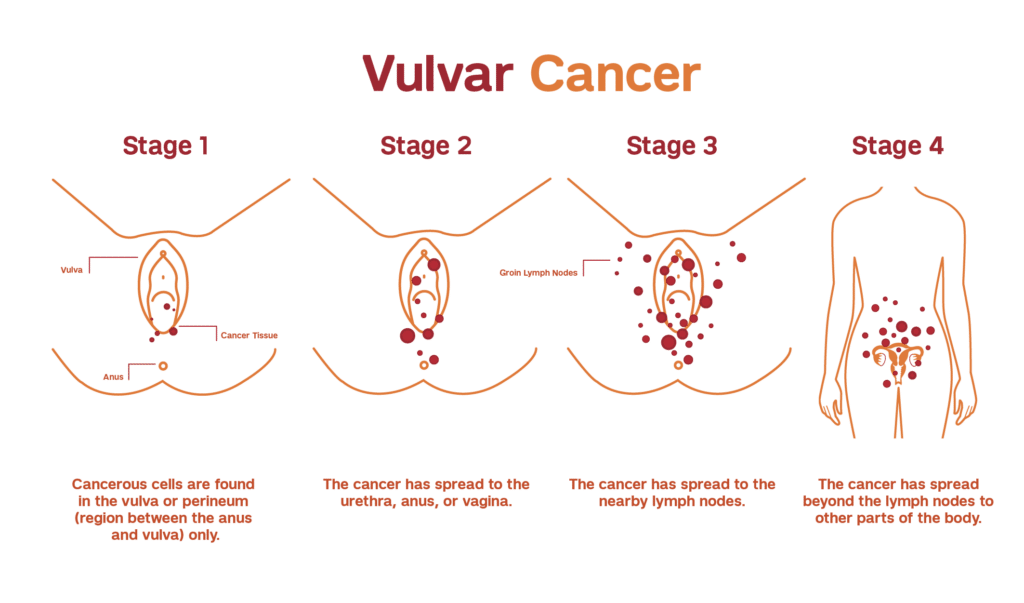 Understanding Vulval Cancer Understanding Vulval Cancer
