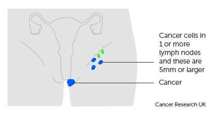 Understanding Vulval Cancer