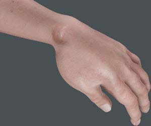 Unveiling Ganglion Cyst Complications: When to Seek Medical Attention