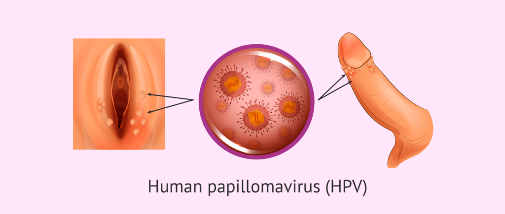 Unveiling the Link between HPV and Genital Warts