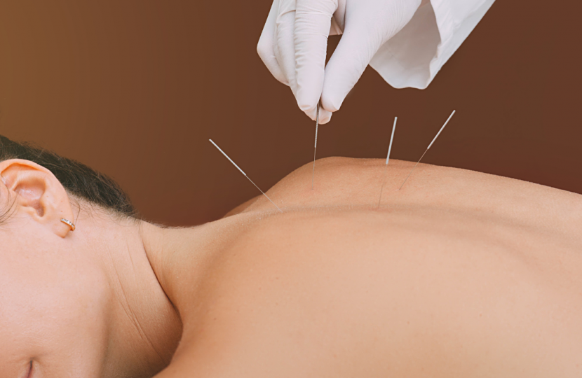 Unveiling the Secrets of Traditional Chinese Medicine: Acupuncture