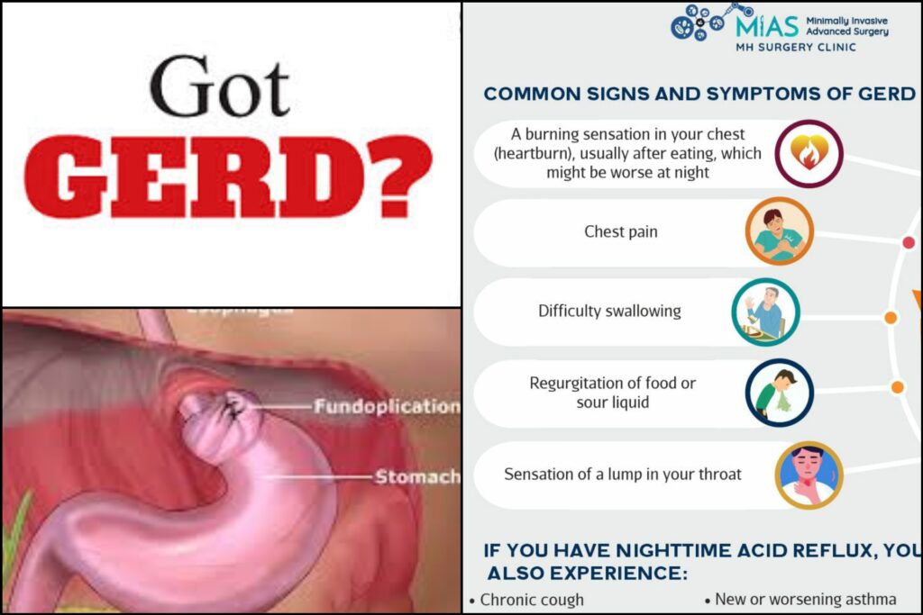 What You Need to Know About GERD