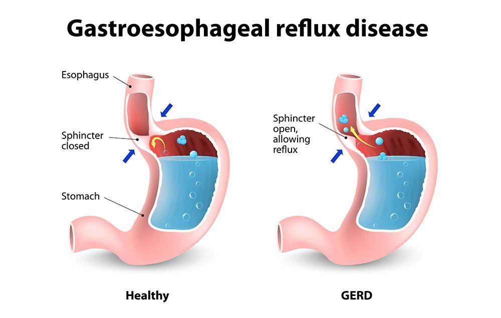What You Need to Know About GERD