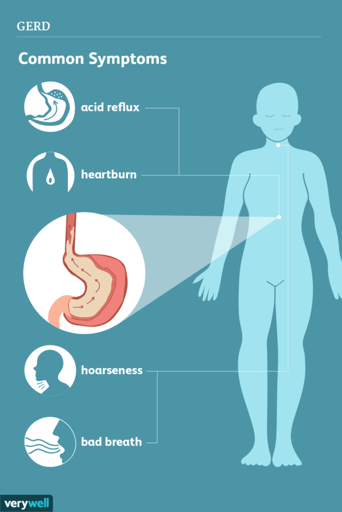 What You Need to Know About GERD
