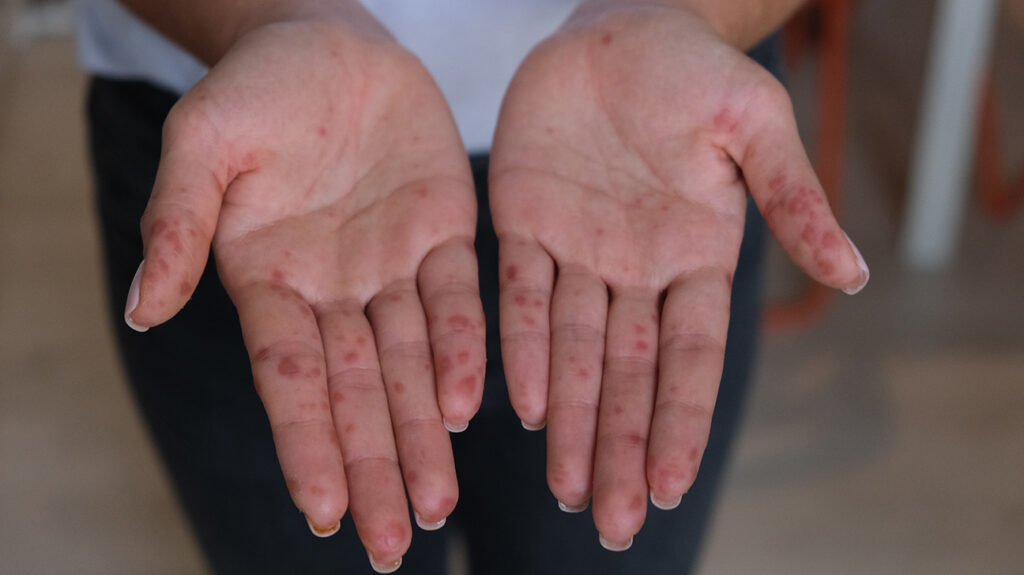 What You Need to Know About Hand, Foot and Mouth Disease