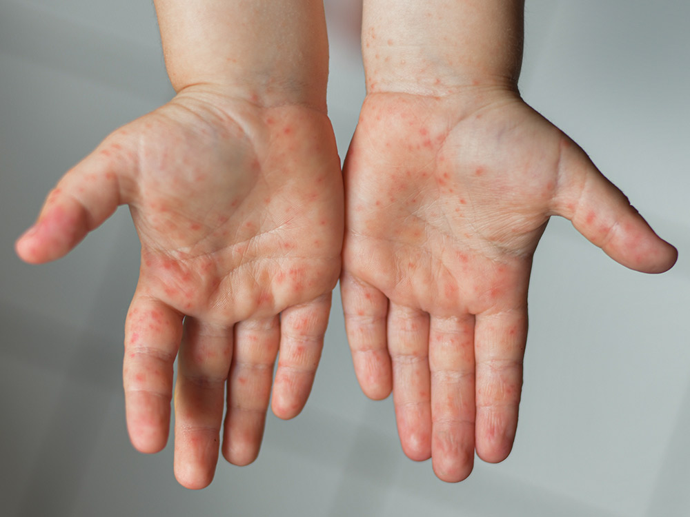 What You Need to Know About Hand, Foot and Mouth Disease