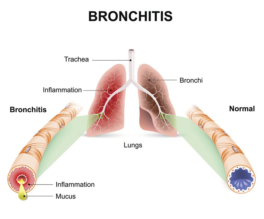 When to Seek Medical Attention for a Chest Infection