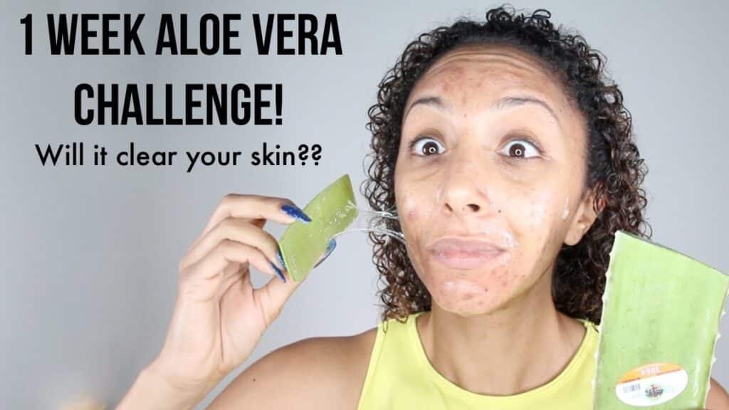 Can Aloe Vera Remove Pimples?