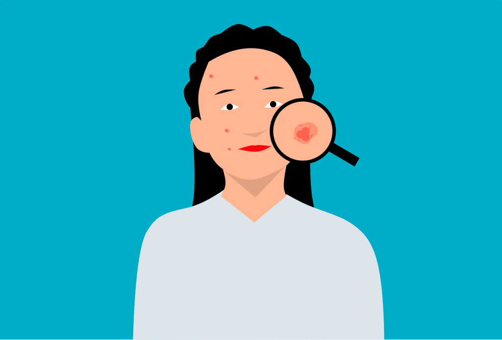 Can Overwashing Cause Acne?