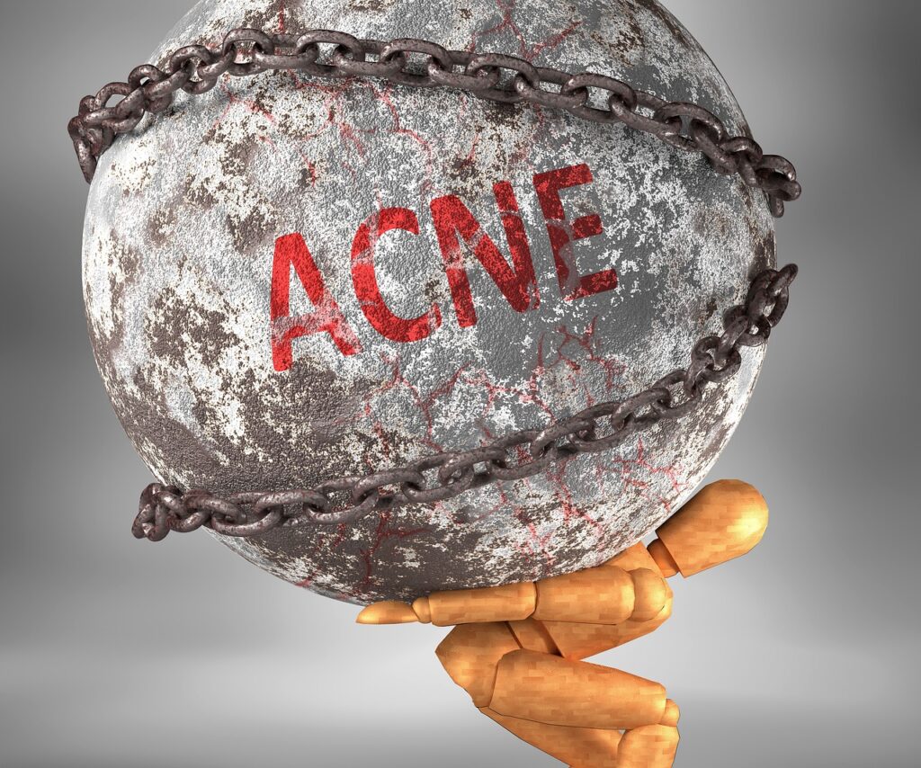 How Does Hormonal Acne Look Like?