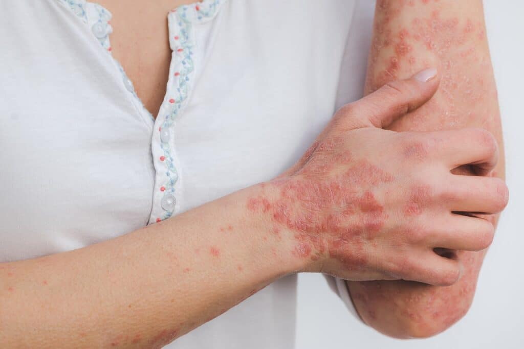 Addressing Psoriasis Underlying Triggers: Remedies to Combat Skin Problems