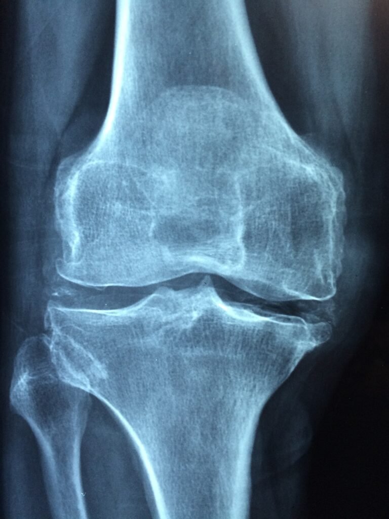 Knee Pain Causes In Young Adults