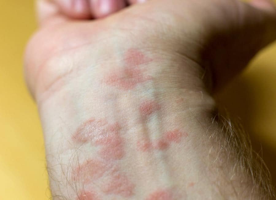 How Does Psoriasis Look When It Starts?