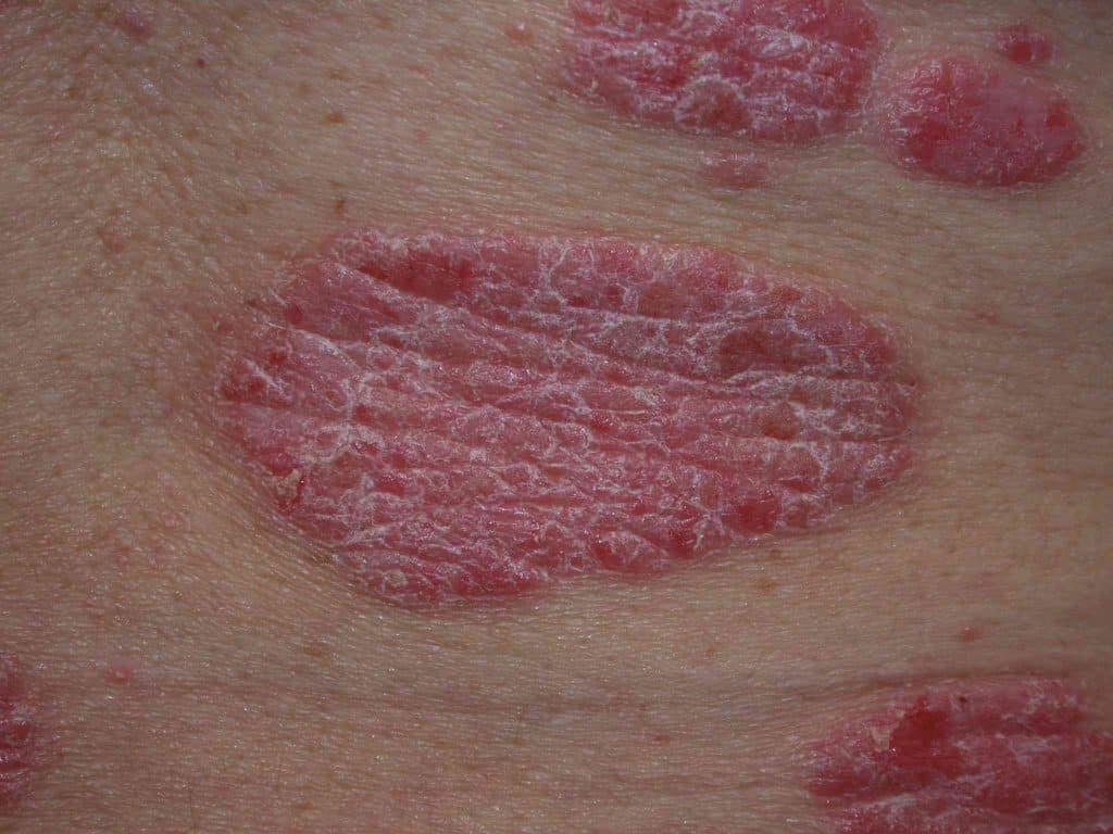 How Does Psoriasis Look When It Starts?