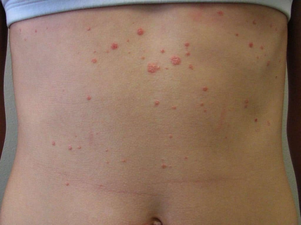 How Does Psoriasis Look When It Starts?