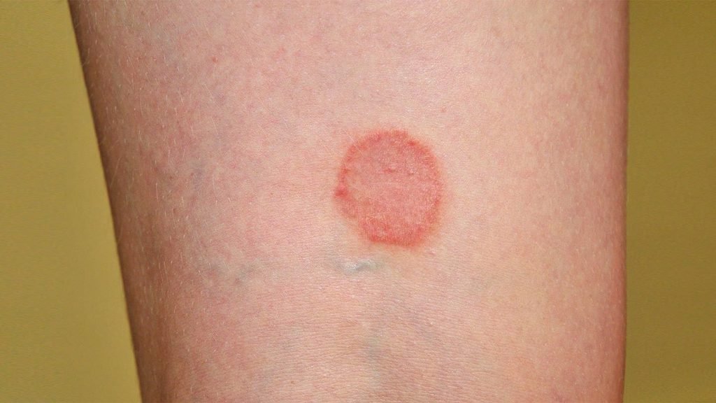 How Does Psoriasis Look When It Starts?