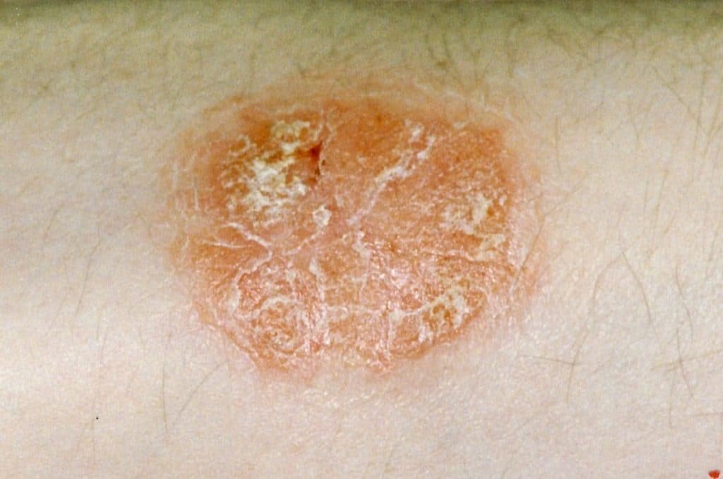 How Does Psoriasis Look When It Starts?