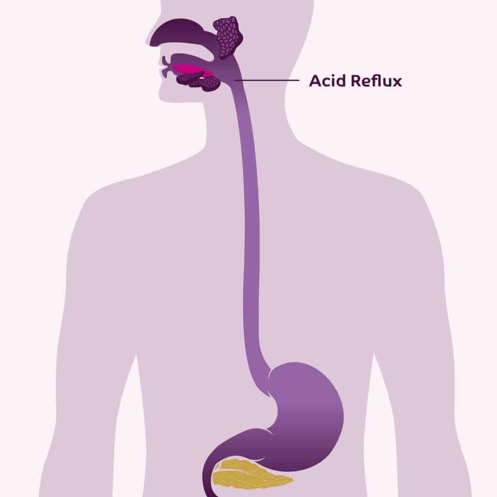 The Ultimate Guide to Acid Reflux Symptoms