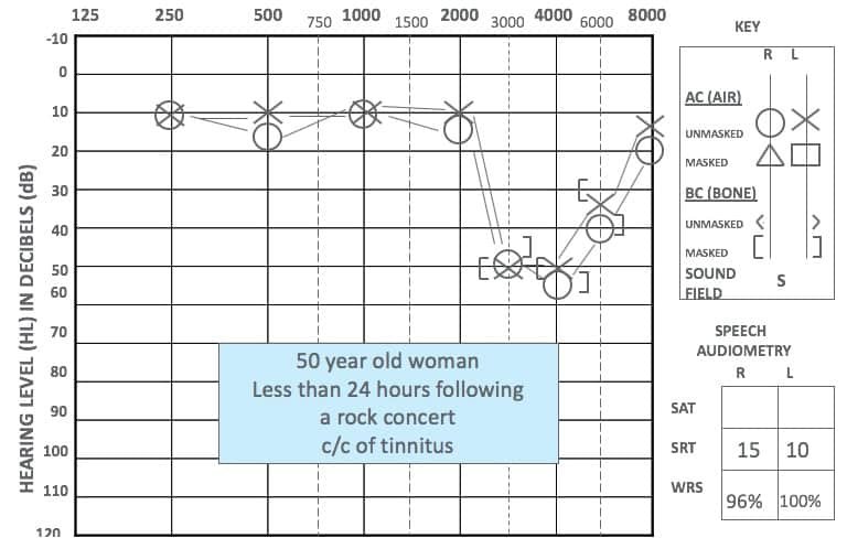 Can Exposure To Loud Noises, Like Firearms Or Explosions, Lead To Tinnitus?