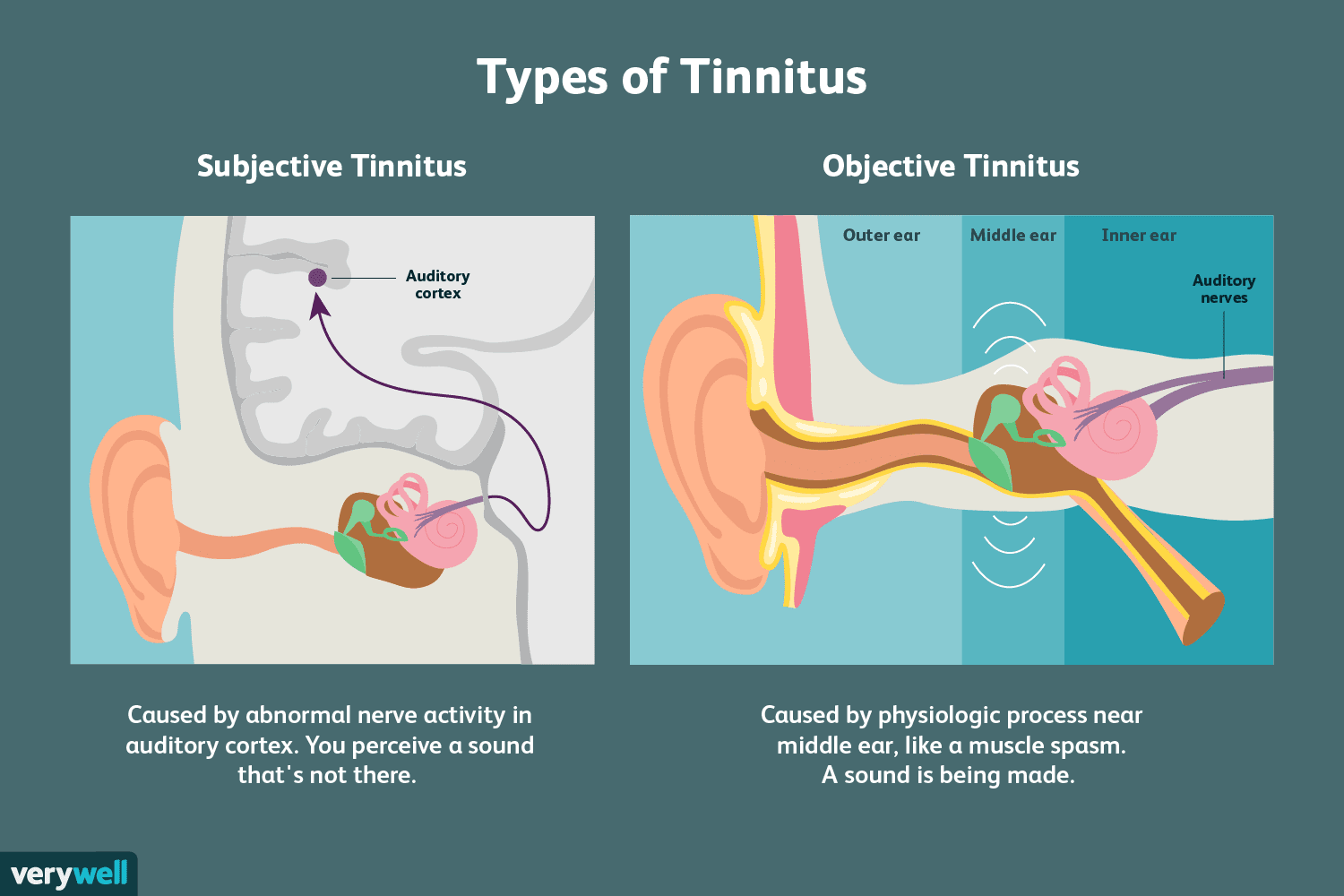 How Can I Distinguish Between Subjective And Objective Tinnitus?