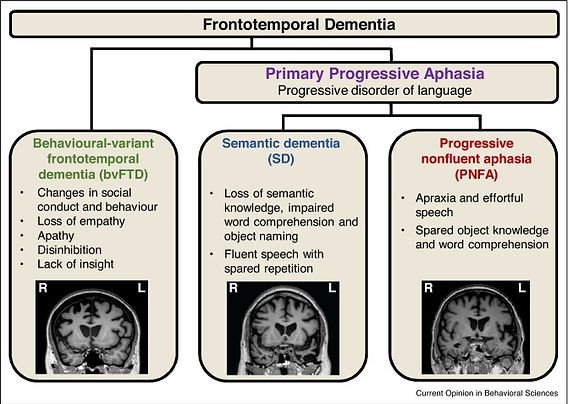 Understanding Frontotemporal Dementia: Symptoms And Treatment